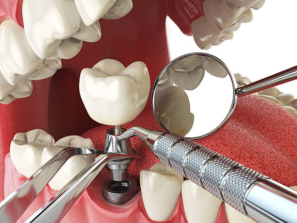 Best Emergency Root Canal Treatment in Richmond, IL